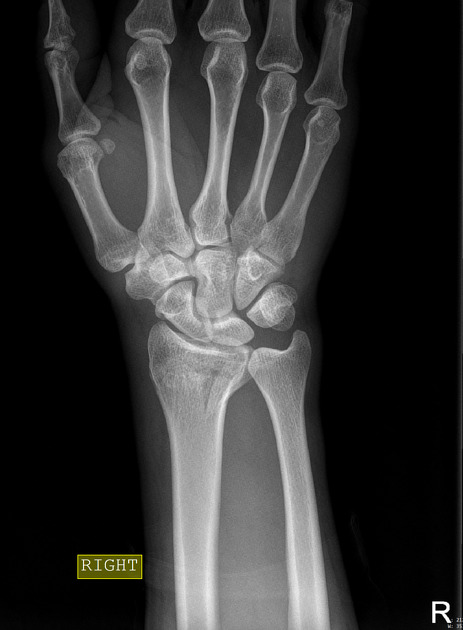 distal radius fracture radiopaedia