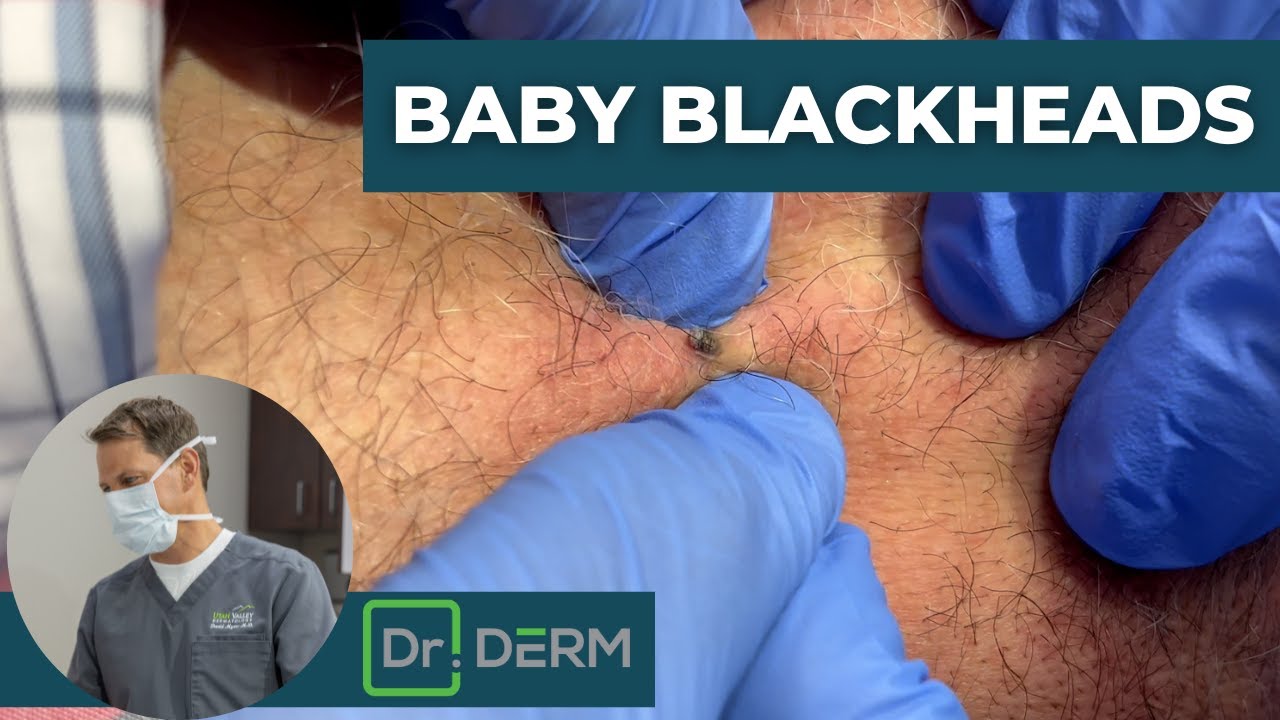 dr derm videos of squeezing blackheads