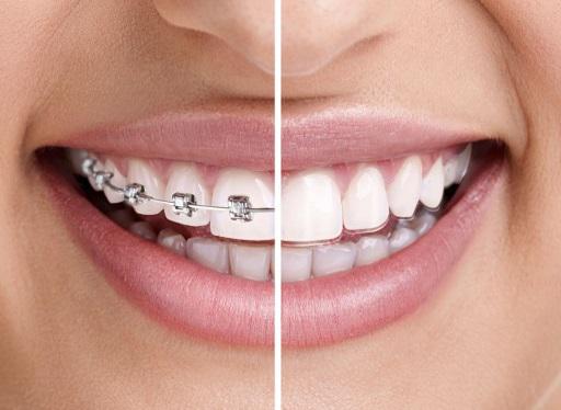 dr smile aligner