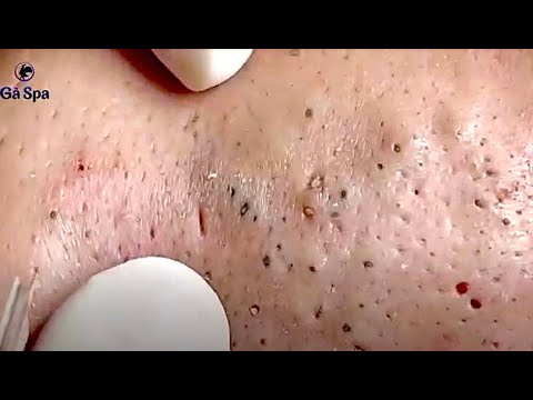 blackheads youtube