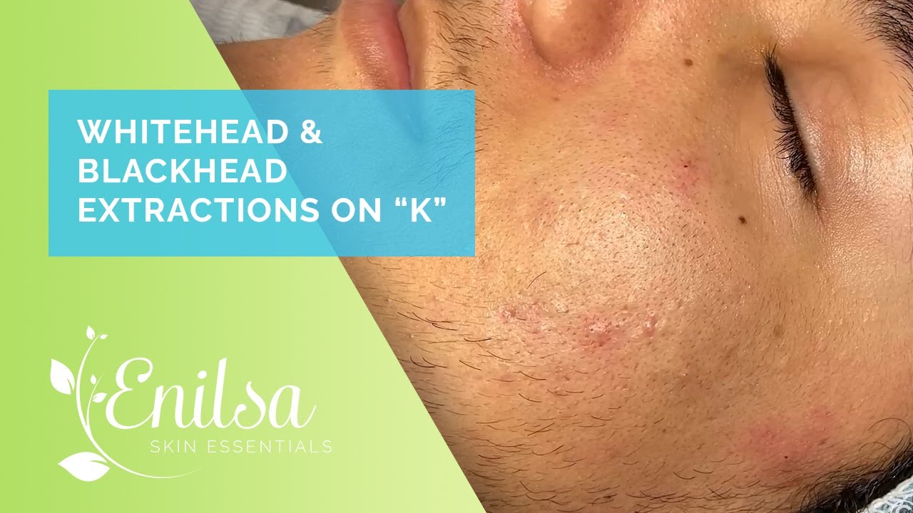 enilsa blackheads