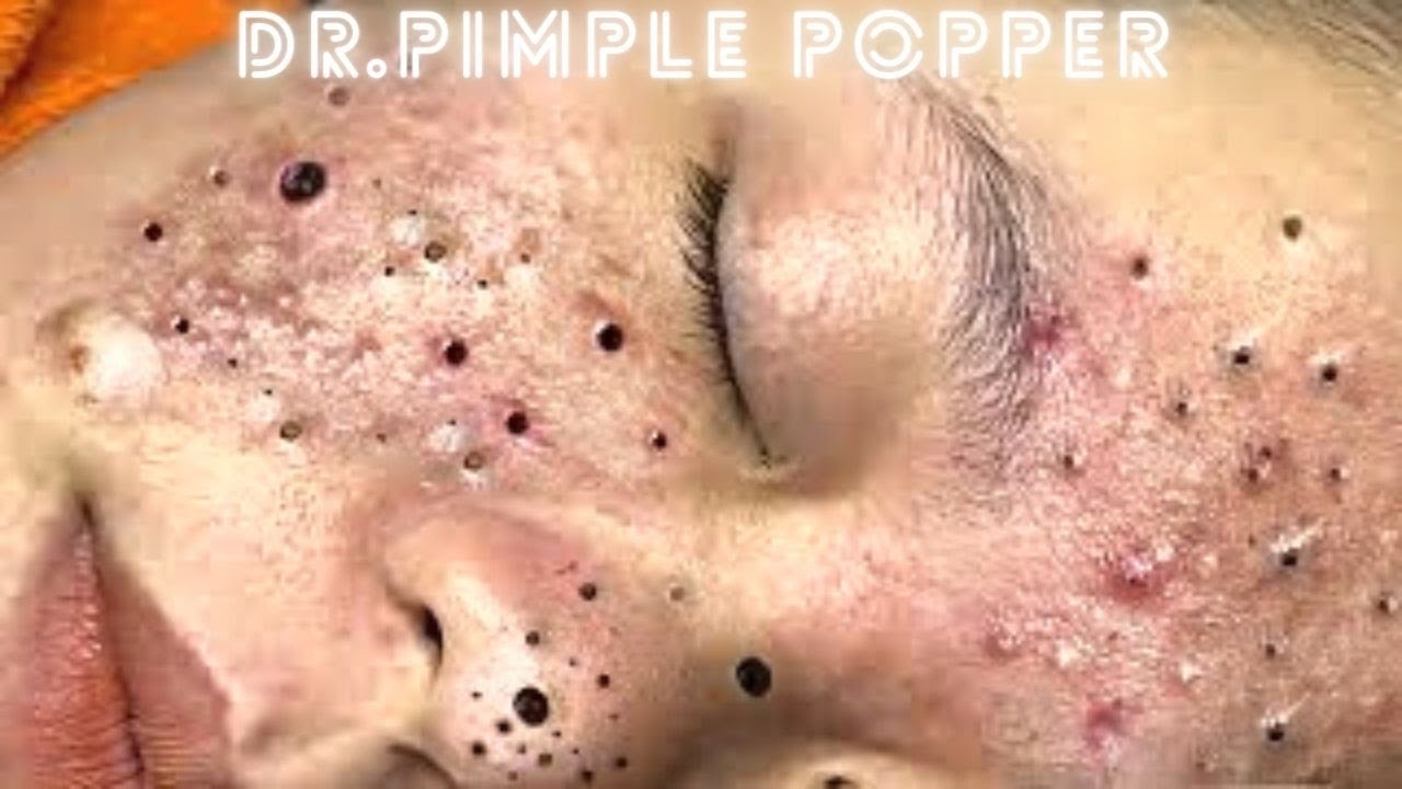 youtube spots and pimples