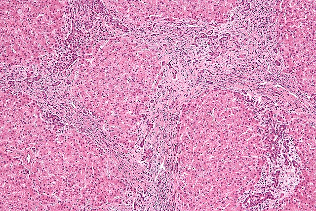 focal nodular hyperplasia liver