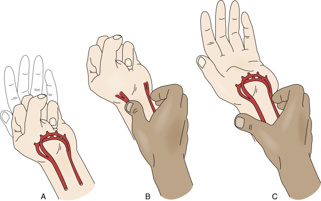 ganglion cyst icd 10