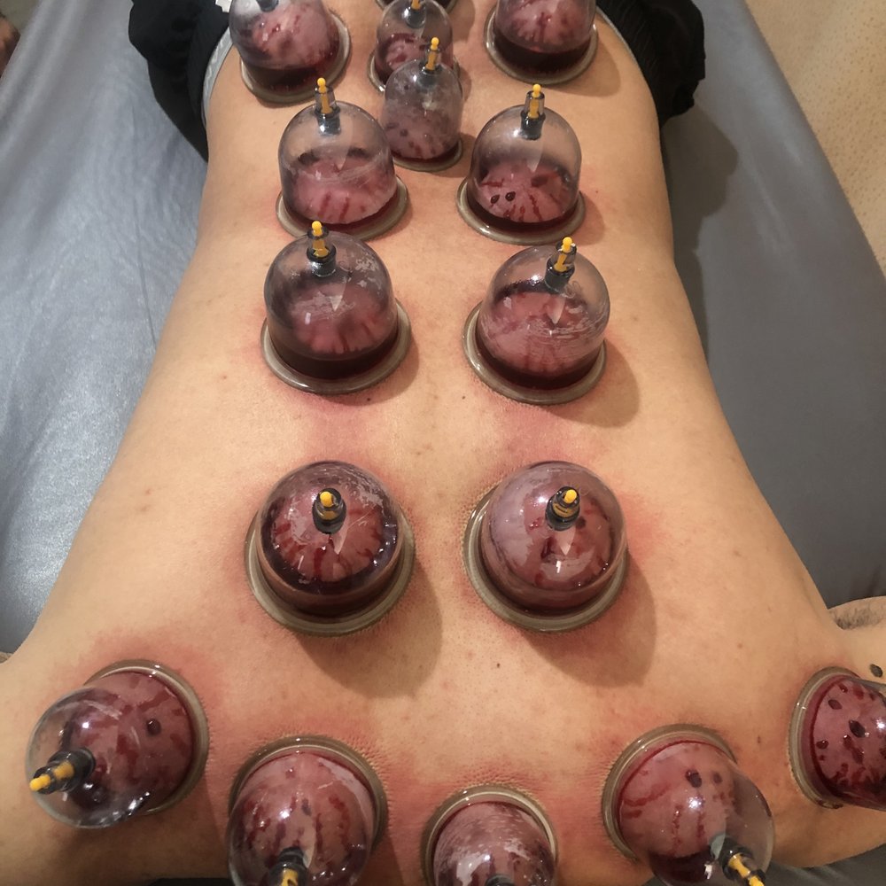 hijama near me