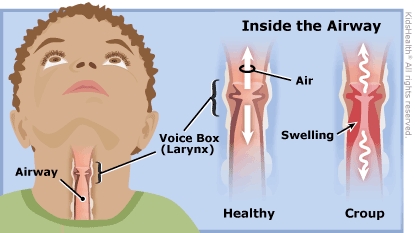 how long is croup contagious nhs