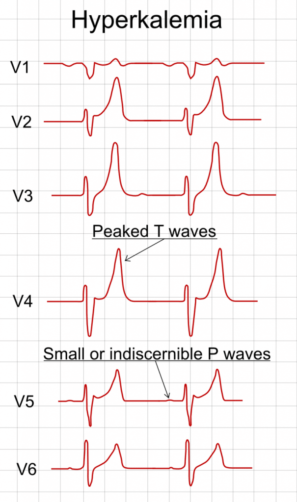 hyperkalemia ecg changes ati