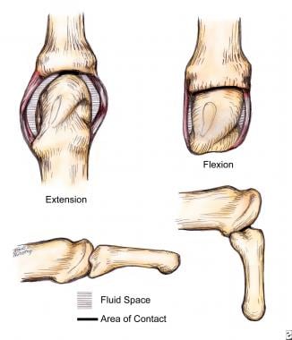 intrinsic plus deformity