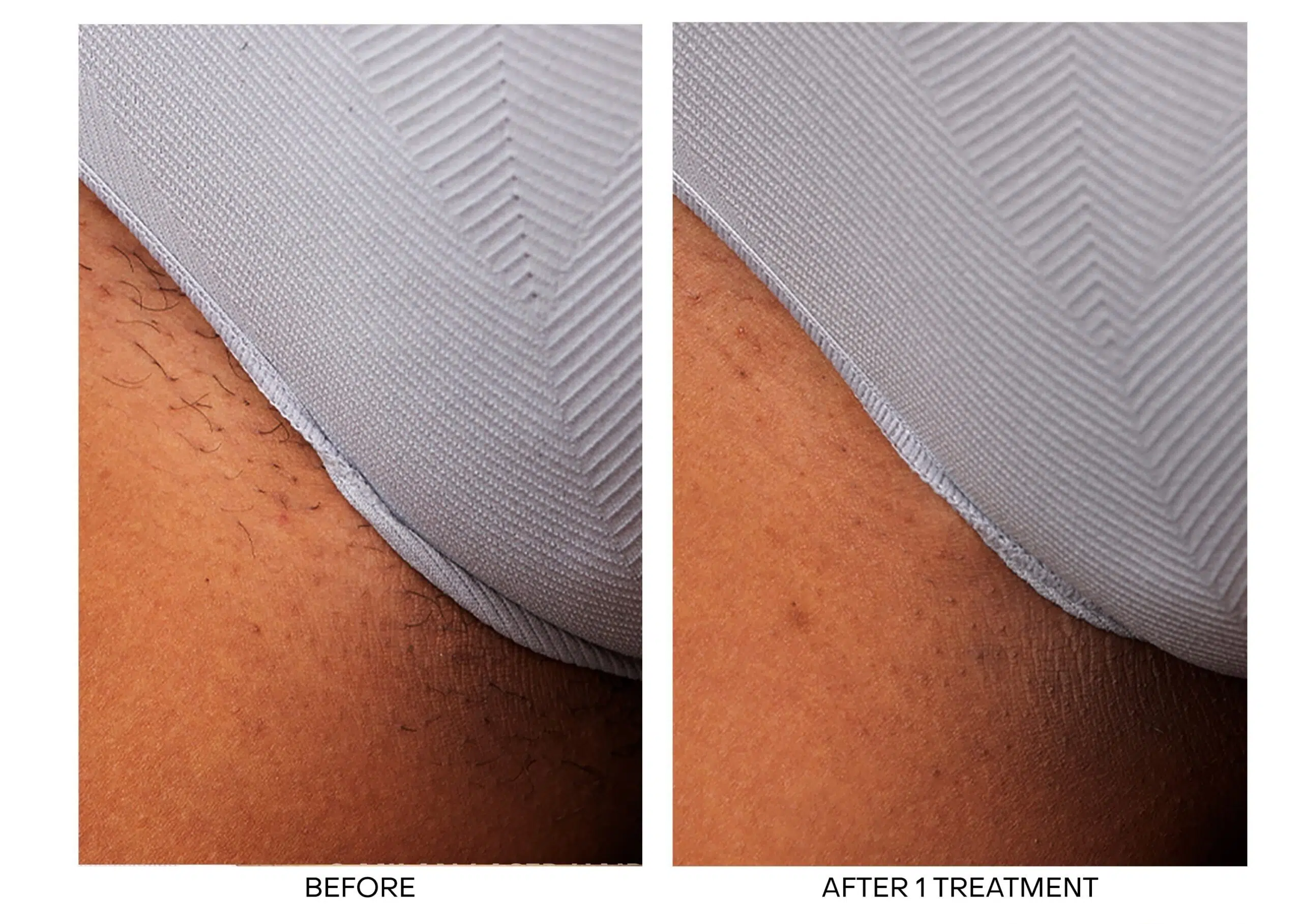 laser hair removal ajax