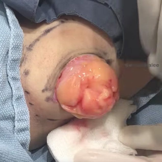 massive pimple popping