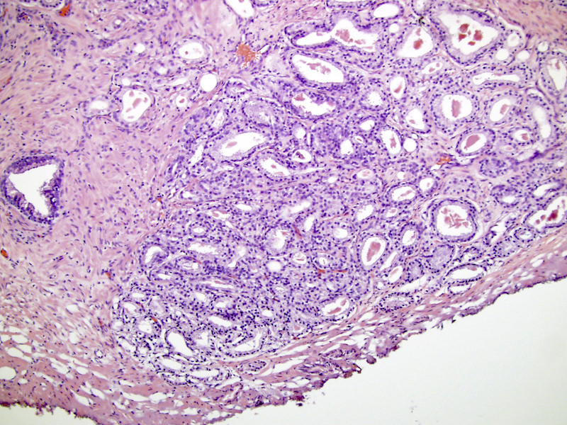 prostate pathology outlines