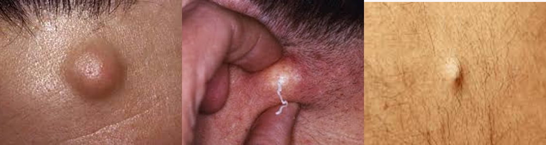 sebaceous cyst removal cost australia