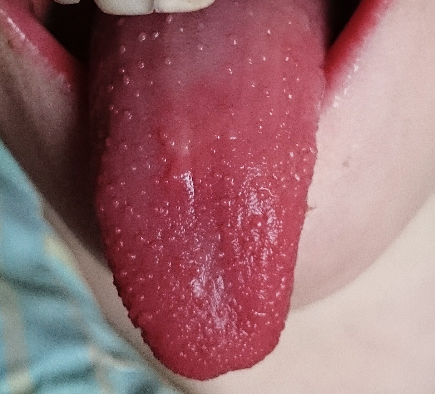 unhealthy tongue pics