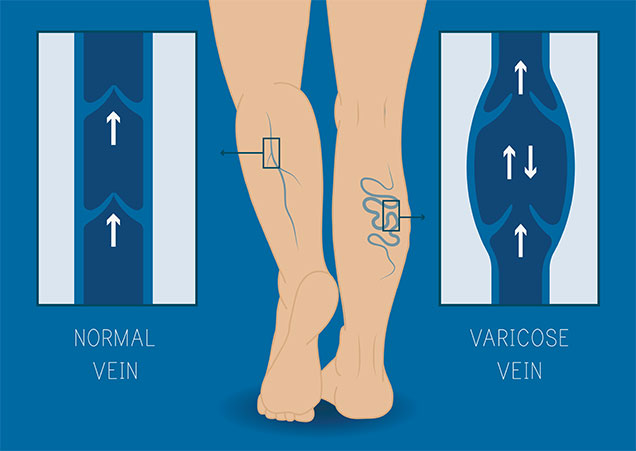 vein reflux icd 10